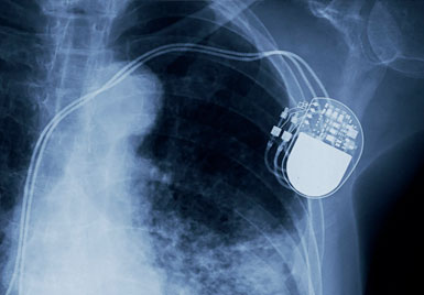 Pacemaker Defibrillator